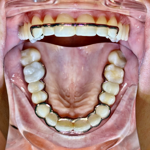 Atlas Maxillary