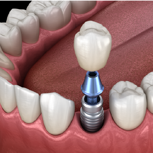 Implant Crown 1