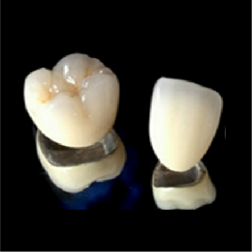 PFM Crown Semi