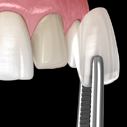 Veneer-1