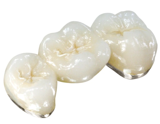 White-Noble-PFM bridge