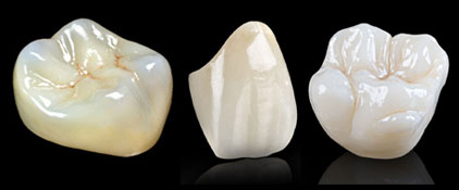 regular-Zirconia-Metal-Crown
